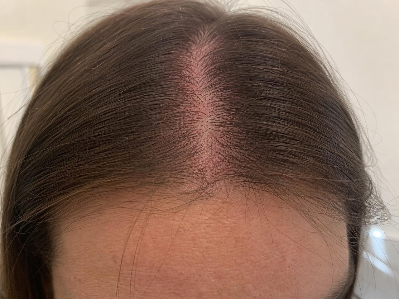 Entzündete, gerötete Kopfhaut als typische Minoxidil-Nebenwirkung
